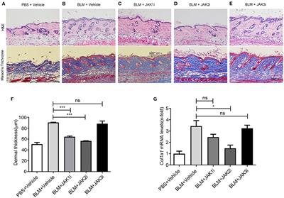 JAK1/2 Inhibitor Baricitinib Improves Skin Fibrosis and Digital Ulcers in Systemic Sclerosis